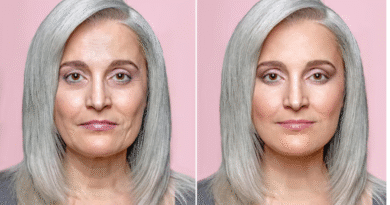 Scăderea masei osoase afectează și estetica facială